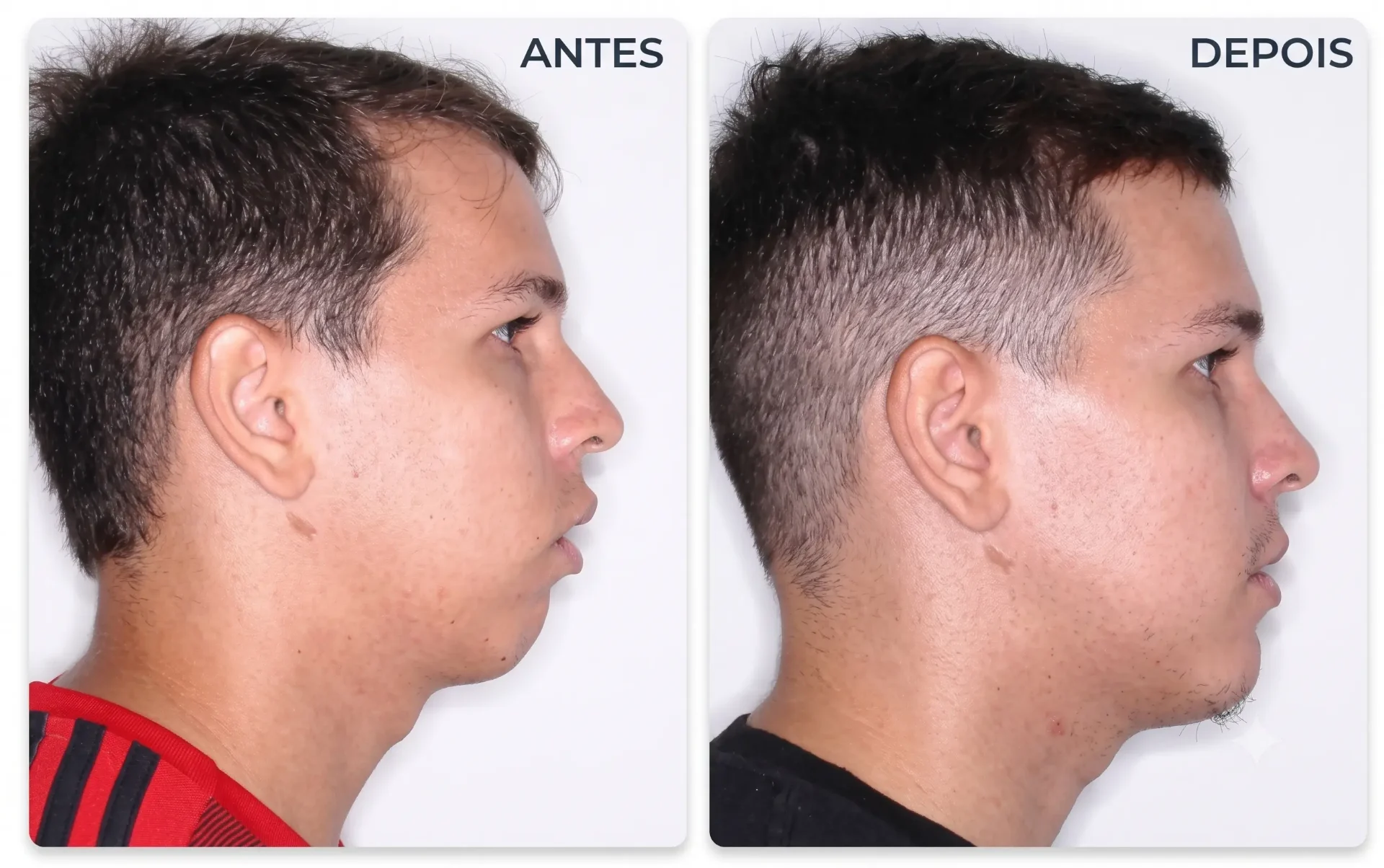 Caso clínico: perfil facial antes e depois da cirurgia ortognática, mostrando reposicionamento da maxila e mandíbula