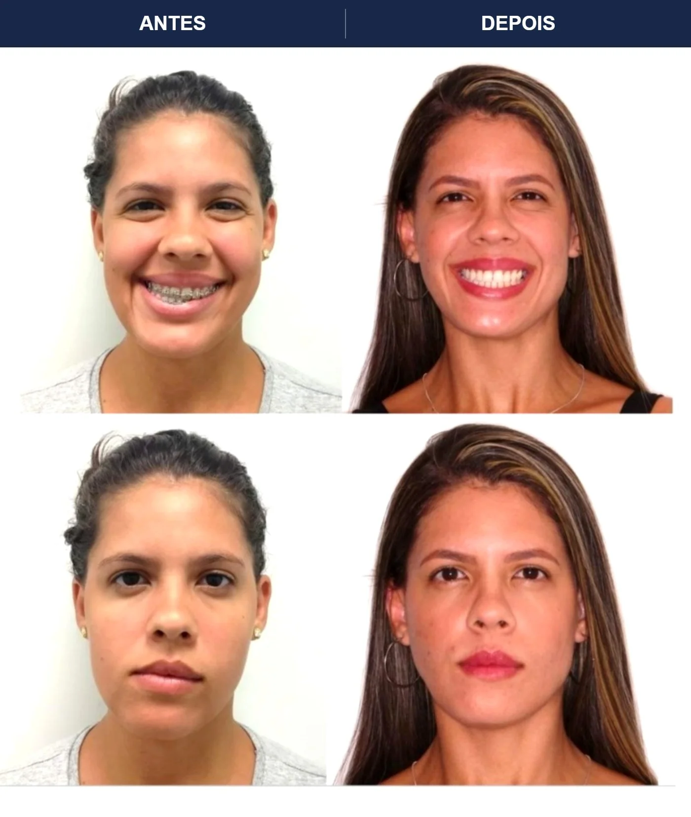 Caso clínico de cirurgia ortognática — Correção de Classe II com equilíbrio facial. Imagens pré e pós-operatórias.