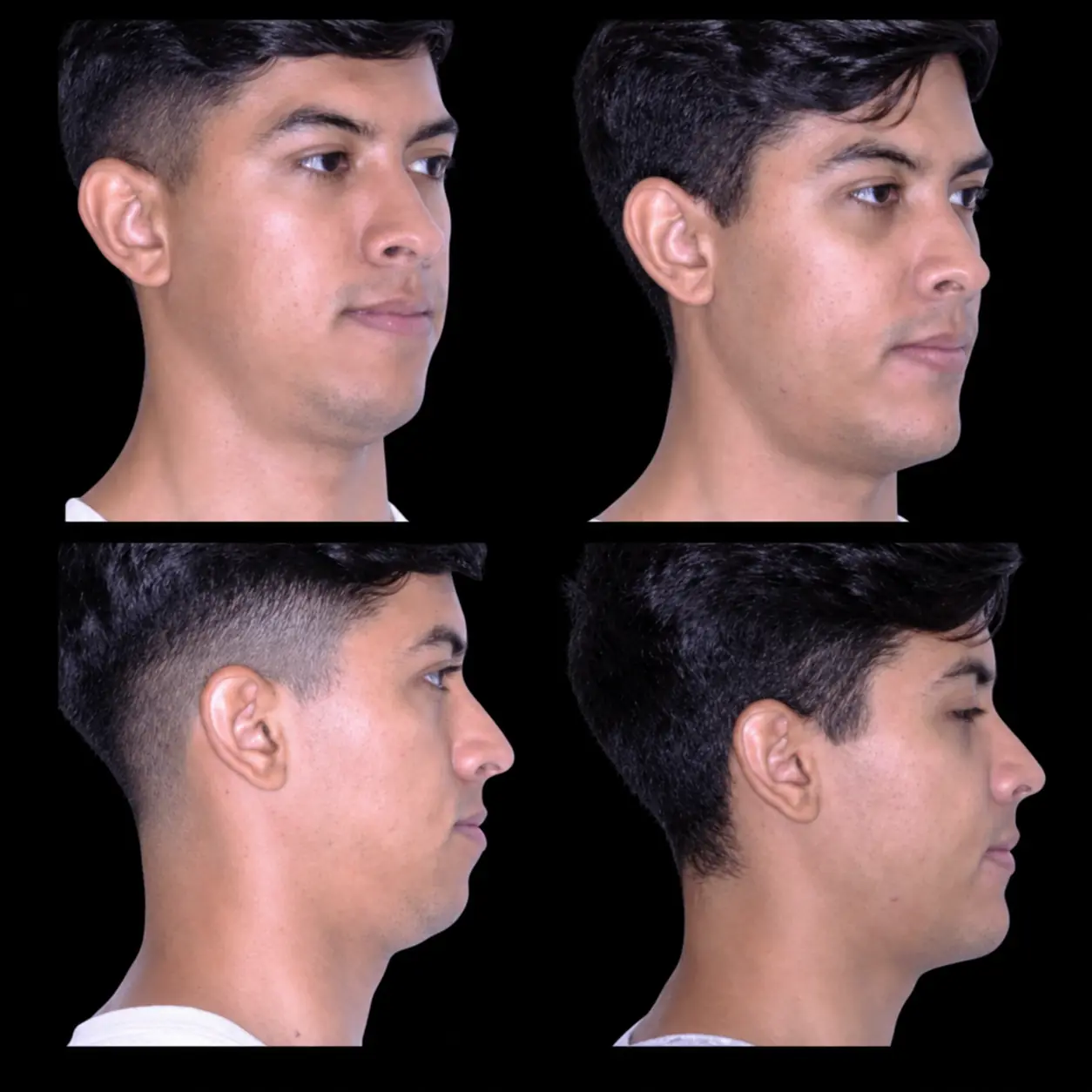 Antes e depois de cirurgia ortognática no Rio de Janeiro — Correção de retrognatismo com definição do contorno mandibular. Fotos pré e pós-operatórias de paciente do Dr. Guilherme Lima, cirurgião bucomaxilofacial.