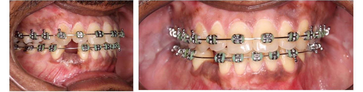 Fotos intraorais com aparelho ortodôntico e espaço sem dente na mandíbula