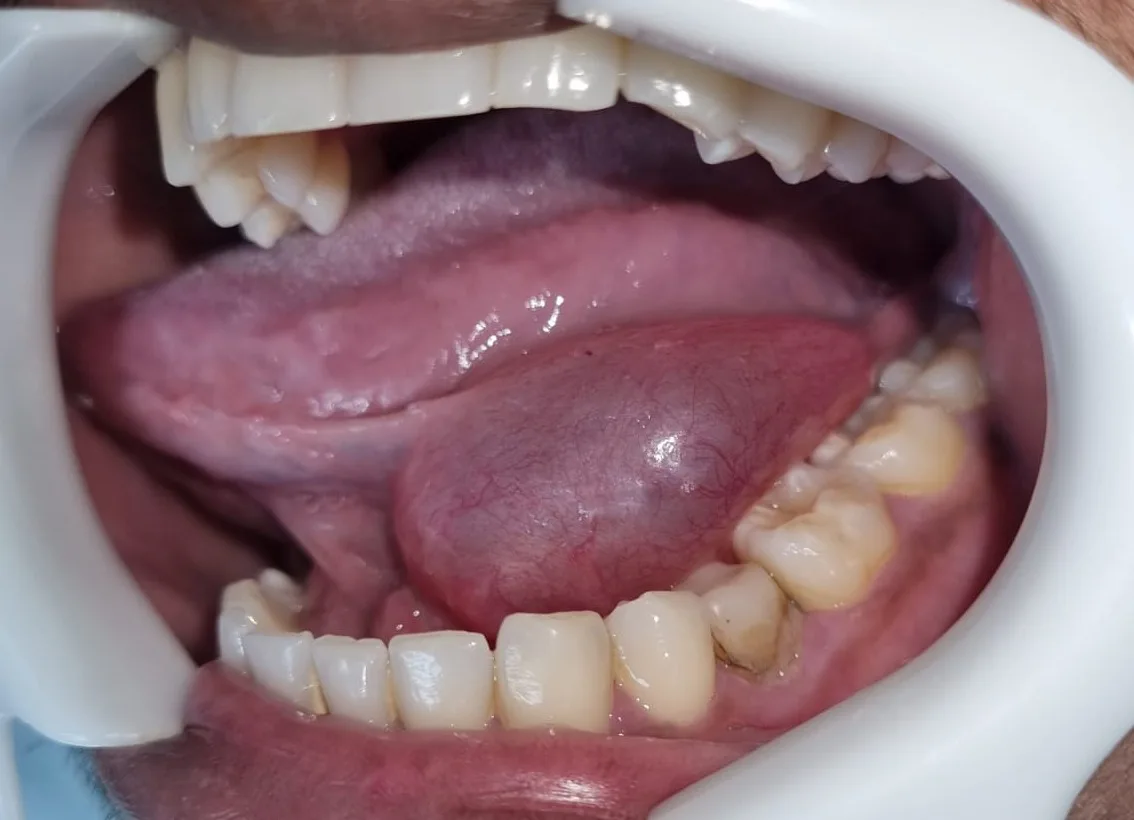 Rânula sublingual, aumento de volume arroxeado embaixo da língua