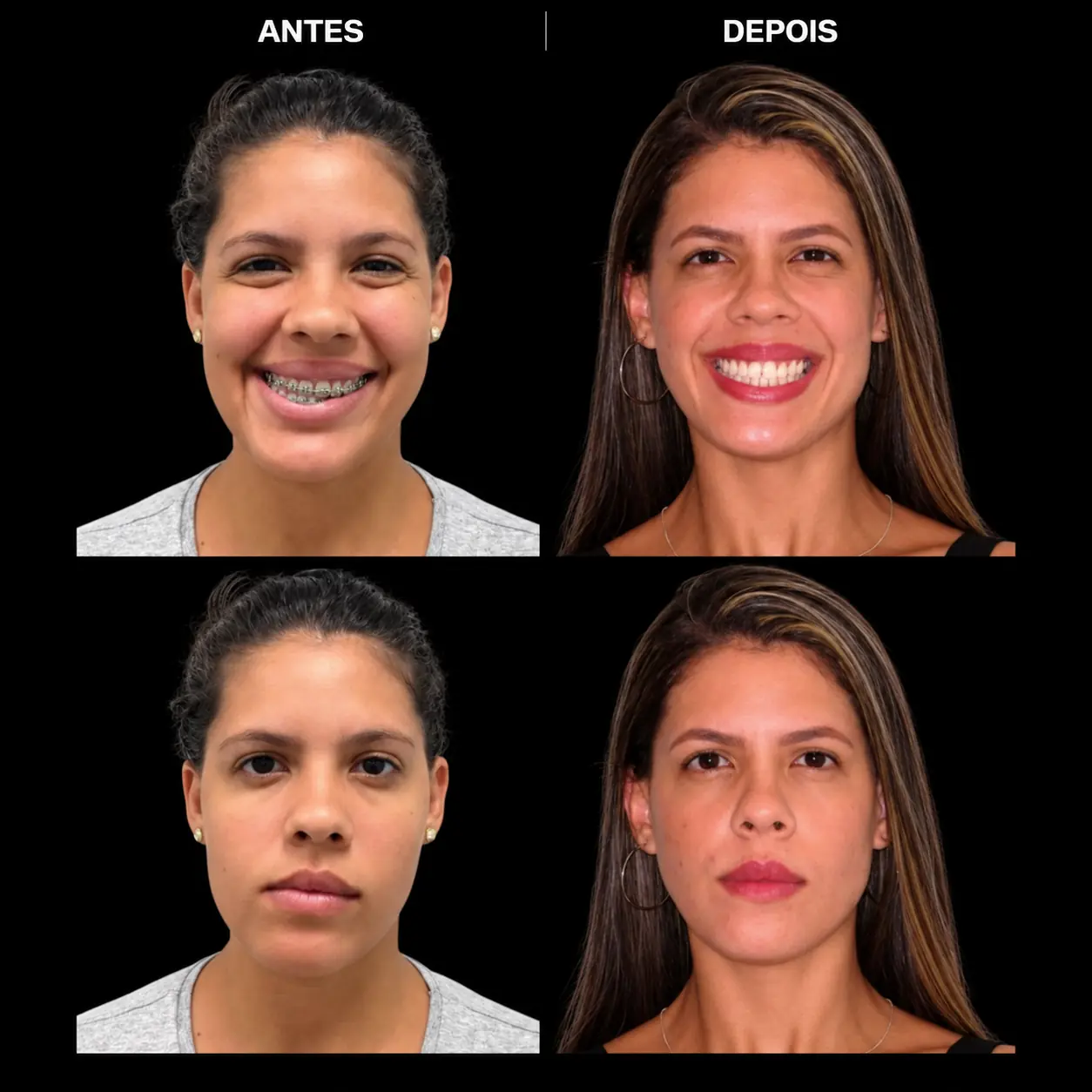 Antes e depois de cirurgia ortognática no Rio de Janeiro — Correção de Classe III — vistas em três quartos e perfil. Fotos pré e pós-operatórias de paciente do Dr. Guilherme Lima, cirurgião bucomaxilofacial.