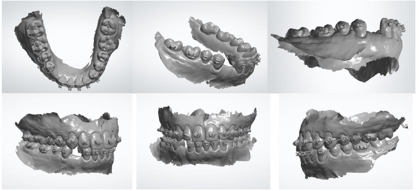 Modelos 3D do escaneamento intraoral pré-implante