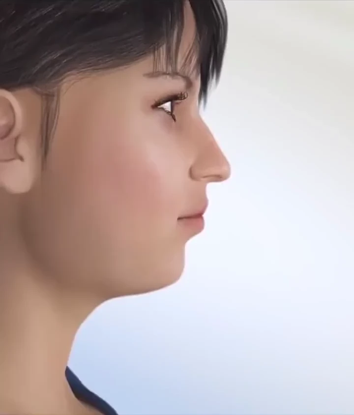 Simulação 3D do perfil facial após reposicionamento dos maxilares