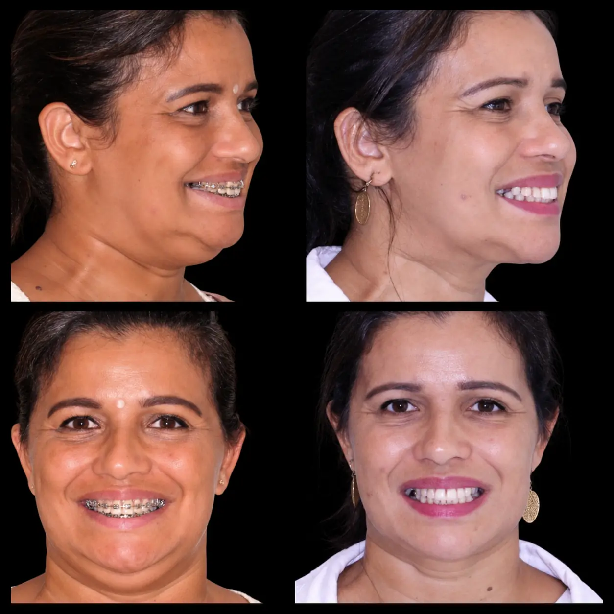 Antes e depois de cirurgia ortognática no Rio de Janeiro — Correção do terço inferior em paciente adulta — vistas frontal e três quartos. Fotos pré e pós-operatórias de paciente do Dr. Guilherme Lima, cirurgião bucomaxilofacial.