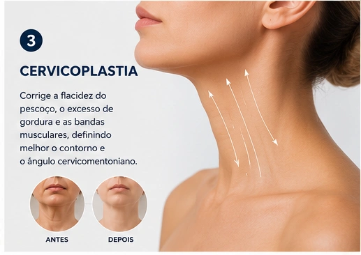 Cervicoplastia — definição do contorno cervical