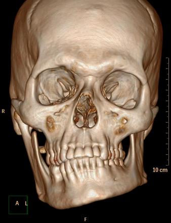 Reconstrução 3D de tomografia do crânio em vista frontal mostrando assimetria da mandíbula, com desvio do queixo e inclinação da mordida