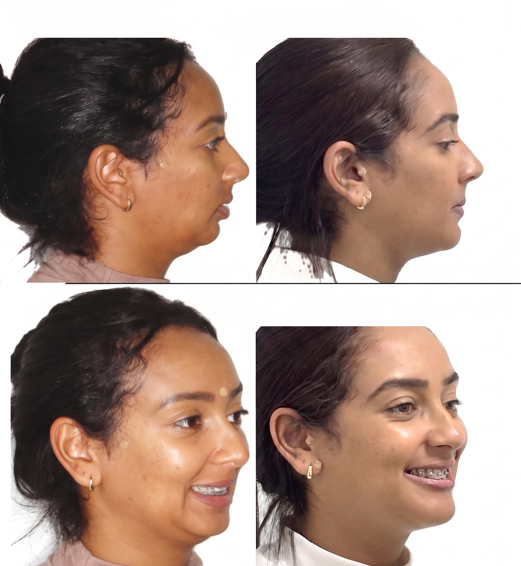 Antes e depois de cirurgia ortognática em Angra dos Reis — paciente feminina, vistas de perfil e oblíqua com aparelho ortodôntico