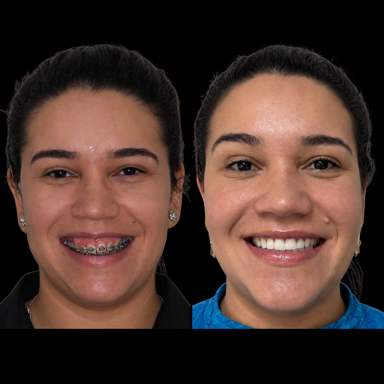 Antes e depois de cirurgia ortognática em Angra dos Reis — paciente feminina, vista frontal do sorriso, tratada pelo Dr. Guilherme Lima