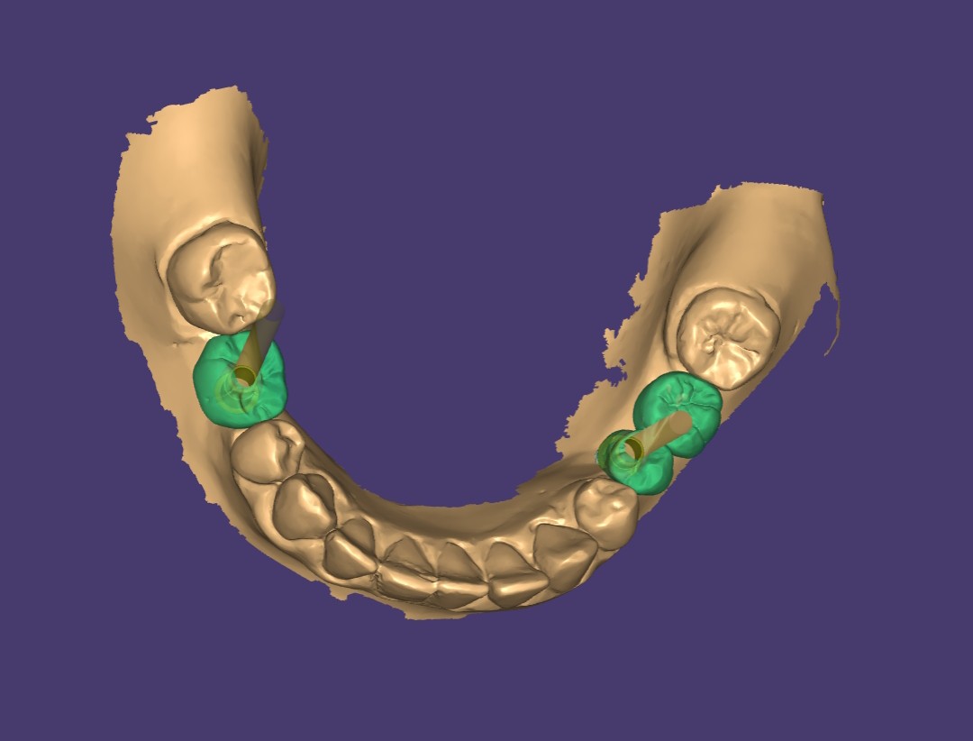 Planejamento virtual de implantes com coroas desenhadas em software