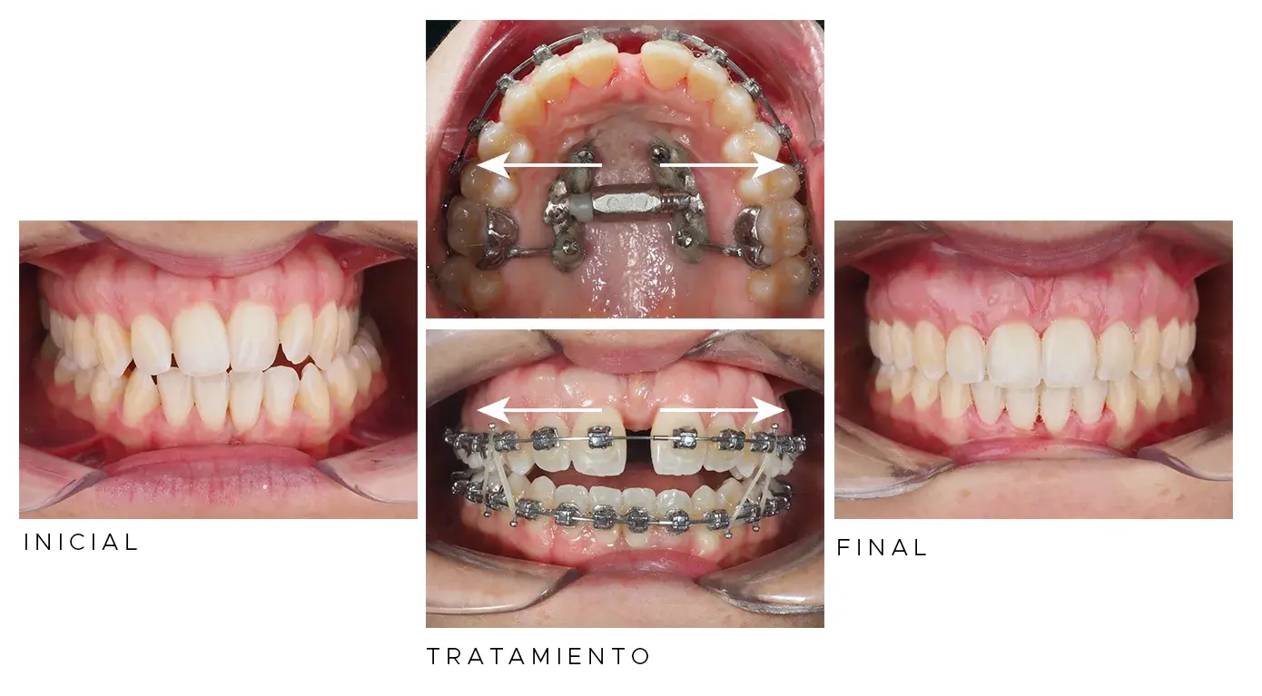 Sequência clínica de expansão maxilar com MARPE: oclusão inicial com mordida cruzada, fase de tratamento com expansor ancorado em mini-implantes e diastema, e oclusão final corrigida
