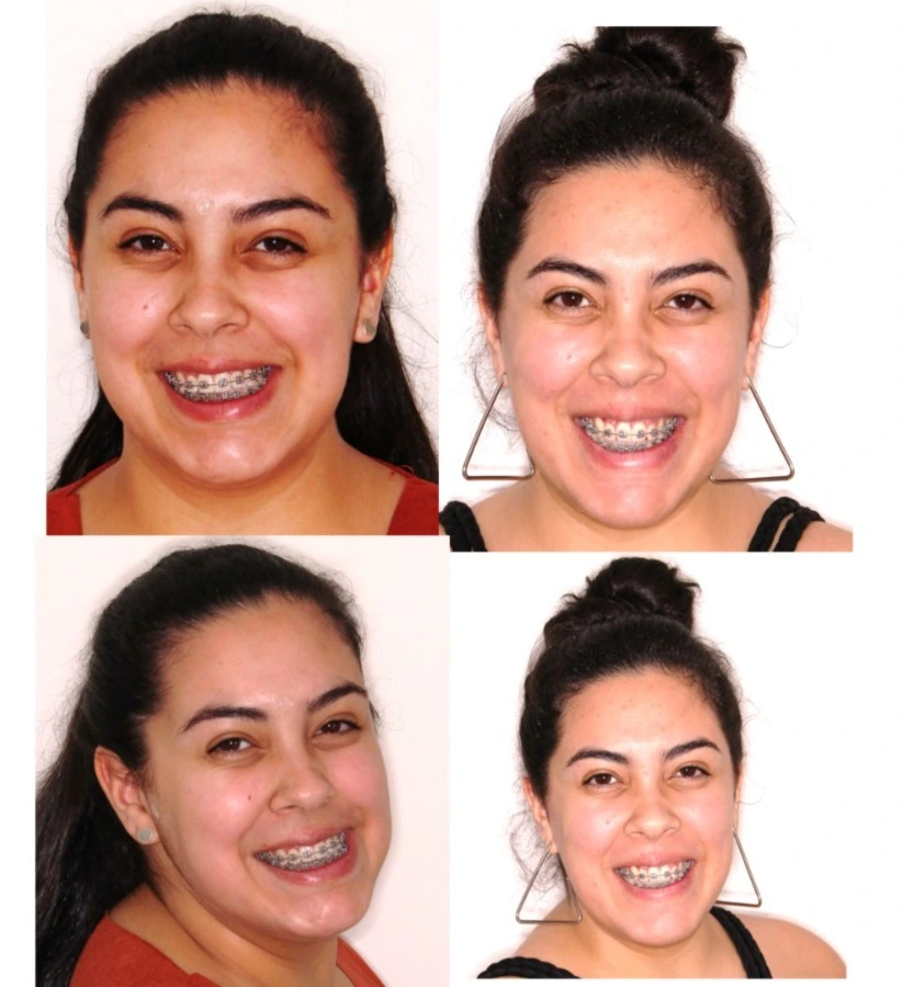 Antes e depois de cirurgia ortognática em Angra dos Reis — paciente feminina, comparativo frontal e oblíquo do terço inferior da face