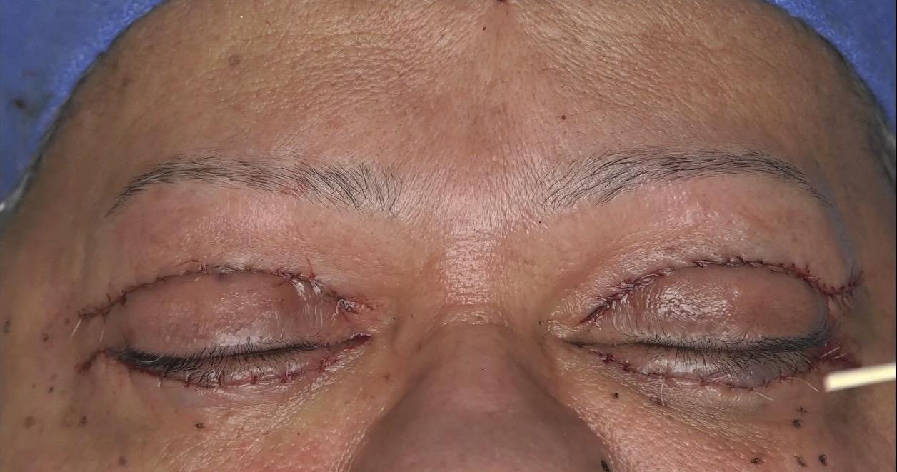 Fotografia transoperatória de blefaroplastia superior e inferior bilateral, com suturas nas linhas de incisão das pálpebras