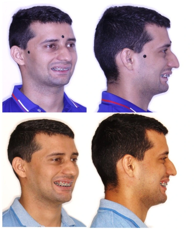 Registro fotográfico pré e pós-operatório de paciente adulto tratado por cirurgia ortognática de Classe II